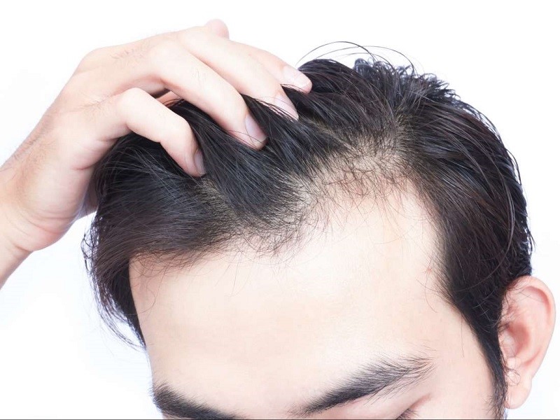 چرا کاشت مو با سلول‌ها‌ی بنیادی