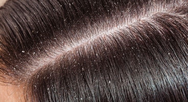 راه حل‌های درمان موارد آسیب زننده به مو